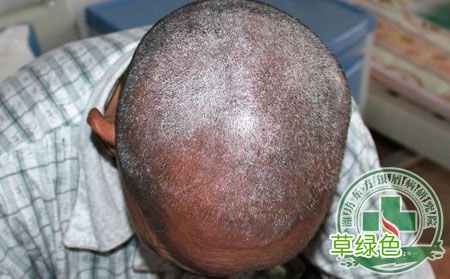 专治牛皮皮癣偏方 牛皮癣怎么治疗