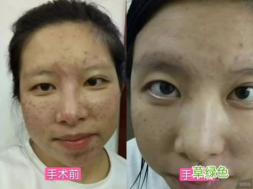 怎样淡化黄褐斑和黄褐斑 如何祛除黄褐斑