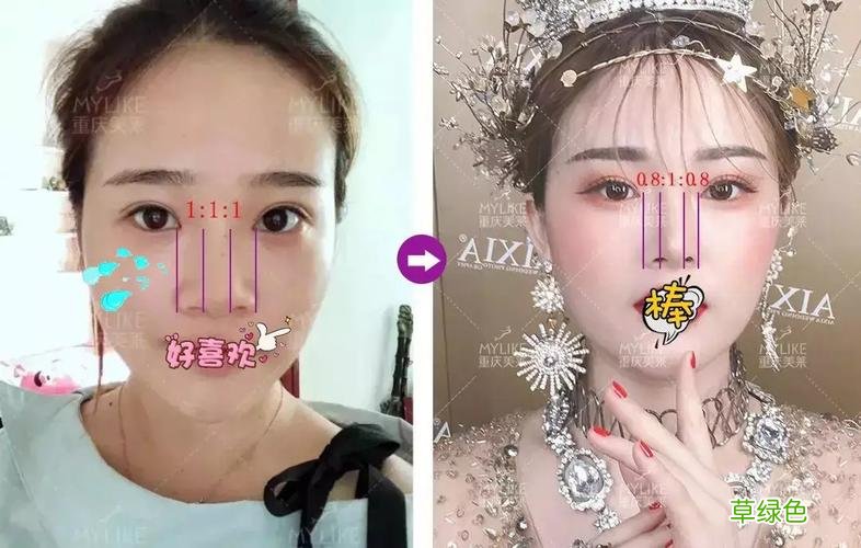 怎样可以缩小鼻翼 鼻翼太大怎么办