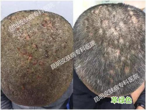 毛囊炎怎么治疗才能除根 毛囊炎怎么治