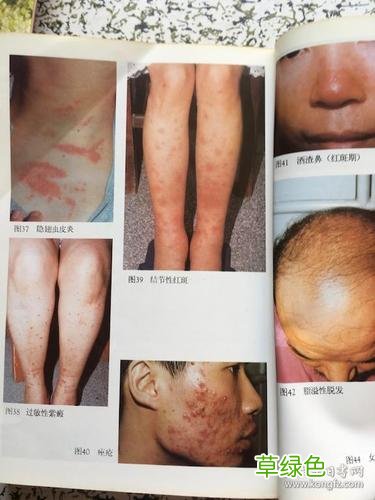 皮肤病治疗 皮肤病的治疗