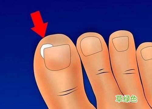 灰指甲刚刚开始什么样图片 什么是灰指甲图片