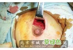 男性乳腺纤维瘤严重吗 乳腺纤维瘤严重吗