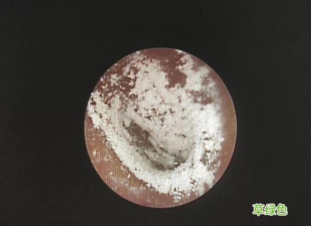 男生念珠菌感染的图片 念珠菌感染图片