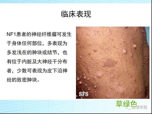 神经性纤维瘤图片 神经性纤维瘤