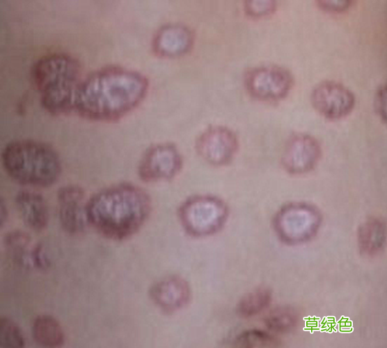 玫瑰糠疹怎么引起的传染别人吗 玫瑰糠疹传染吗