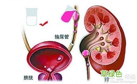 肾积水是怎么回事 肾积水怎么治疗