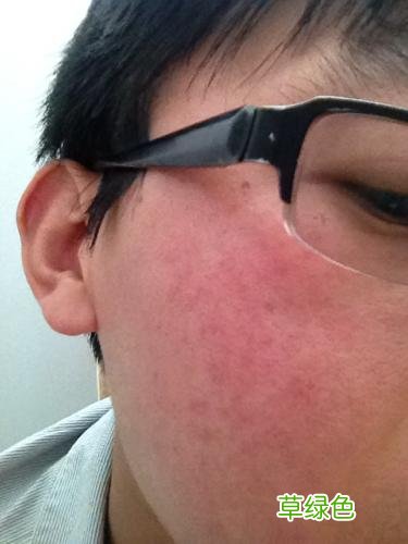 皮肤上有红色血丝是怎么回事 皮肤出现红血丝