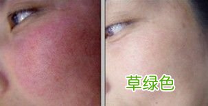 皮肤薄红血丝怎么修复 皮肤薄红血丝