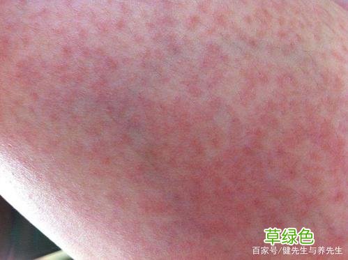皮肤对阳光过敏用什么药 皮肤对阳光过敏