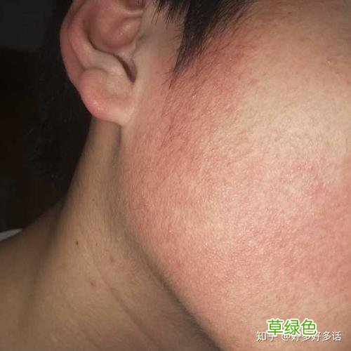 毛周角化症图片脸部两侧 毛周角化症图片