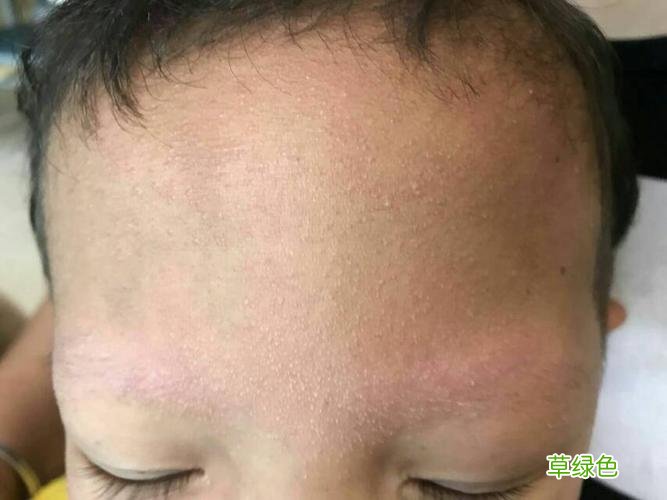 毛周角化症图片脸部两侧 毛周角化症图片