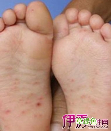 儿童病毒性疱疹怎么引起的,如何治疗 儿童病毒性疱疹