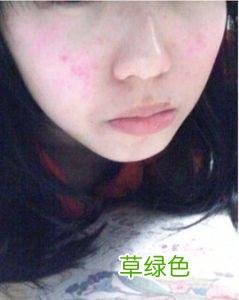 皮肤过敏了怎么办最快方法止痒 皮肤过敏怎么止痒