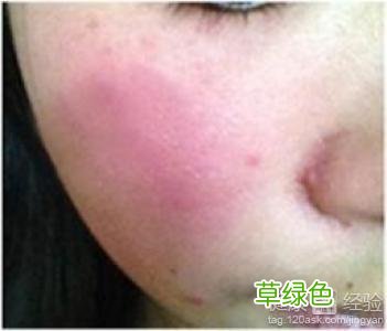 面部皮肤过敏吃什么药 面部过敏吃什么药