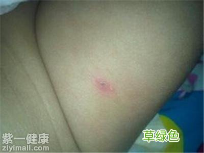 病毒性疱疹症状有哪些 病毒性疱疹症状