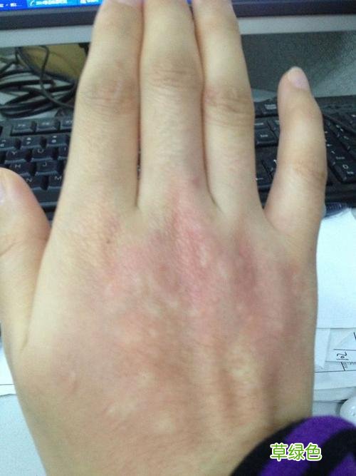 脚生了冻疮了怎么办 生冻疮怎么办