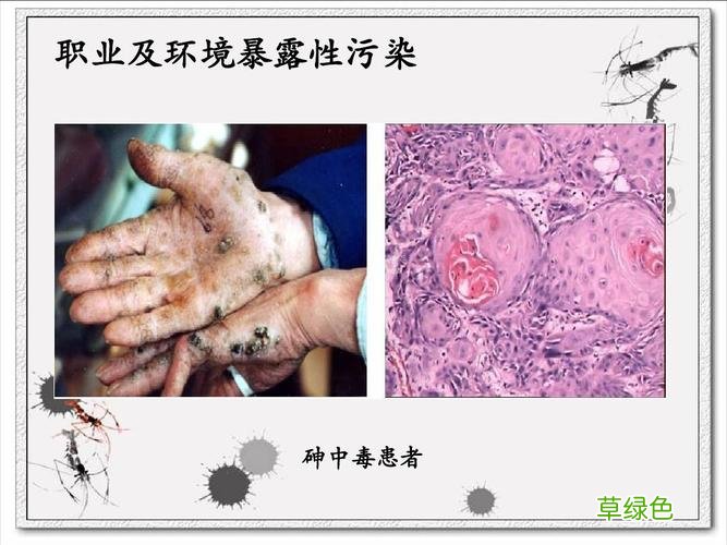 砒霜中毒症状不典型 砒霜中毒症状