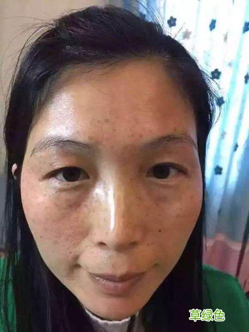 面部色斑按摩可以去除吗 面部色斑怎么去除