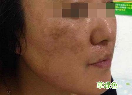 皮肤色斑怎么治疗 色斑怎么治疗