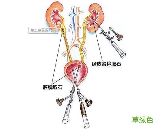 肾结石怎么引起的男性 肾结石怎么引起的