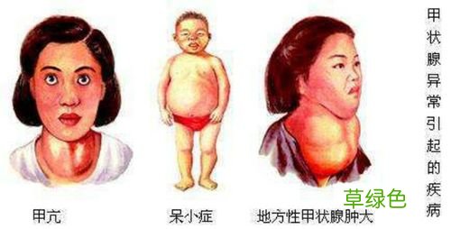 大脖子病有什么症状 什么是大脖子病