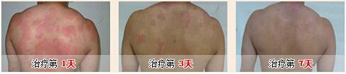 荨慢性麻疹该怎么治疗 慢性荨麻疹的治疗