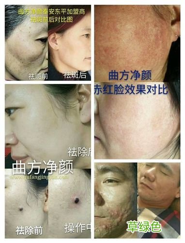 如何祛斑安全有效 男人如何祛斑