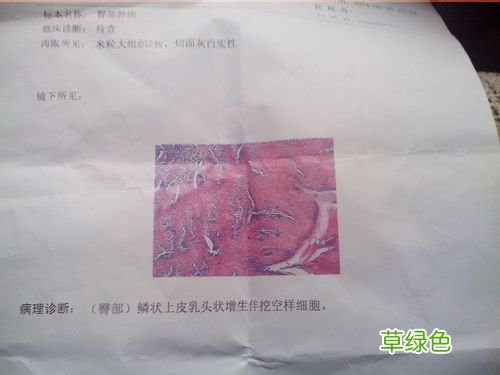 如何检测尖锐湿疣
