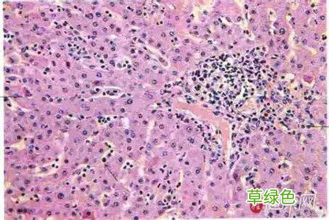 阑尾慢性炎是怎样症状 慢性阑尾炎症状
