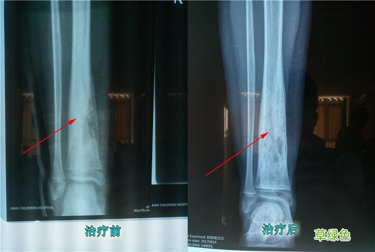 骨髓炎怎么治疗 什么是骨髓炎