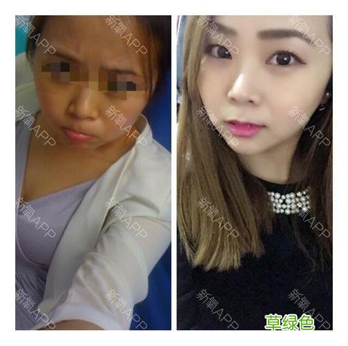 全身美白针效果怎么样 美白针效果怎么样