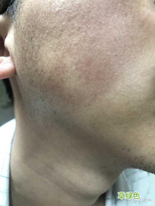 脸上毛周角化症怎么治 毛周角化症怎么治