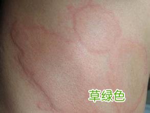 荨麻疹治疗 慢性荨麻疹治疗