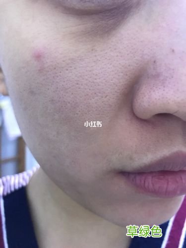全身皮肤又黑又粗糙怎么办 皮肤黑粗糙怎么办