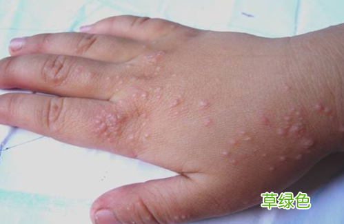 湿疹的最好的治疗方法 男性湿疹治疗方法