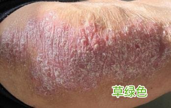 牛皮癣是怎样得的