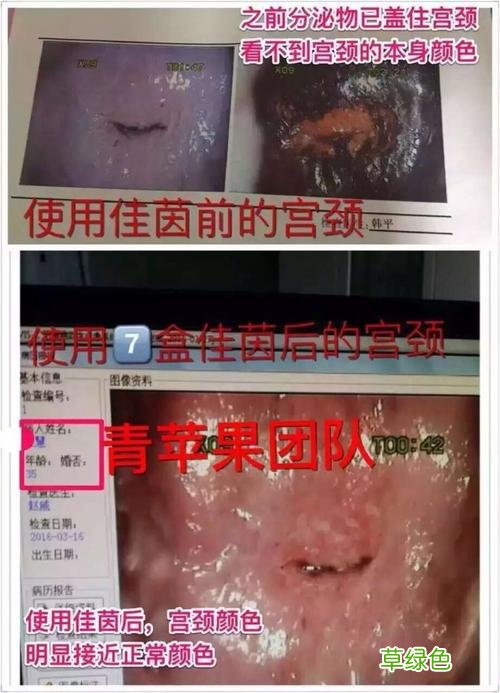 妇科宫颈糜烂怎么治疗 如何治疗宫颈糜烂