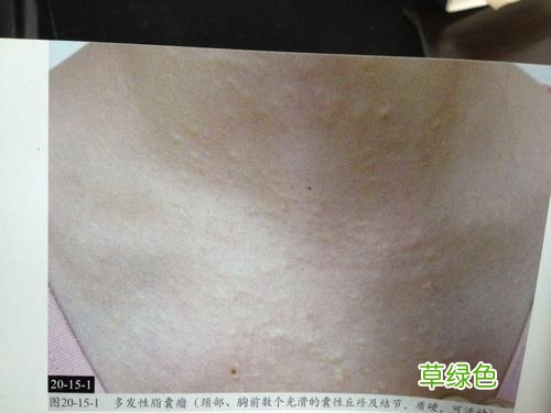 皮脂腺囊肿图片早期症状 皮脂腺囊肿图片
