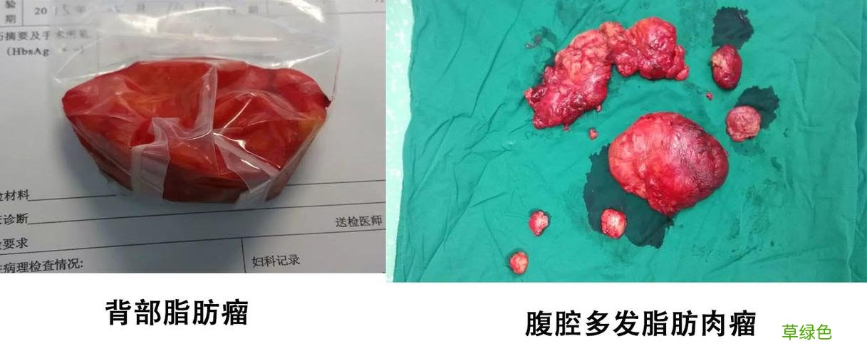 皮脂腺囊肿图片早期症状 皮脂腺囊肿图片