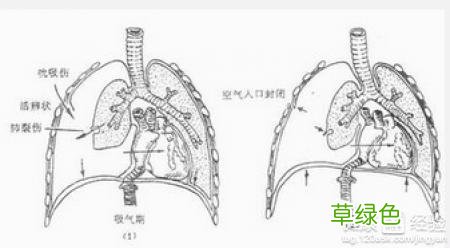 胸胀气是什么原因引起的 气胸是怎么回事