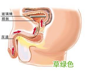 男性尿结石的症状有哪些 男性尿结石的症状