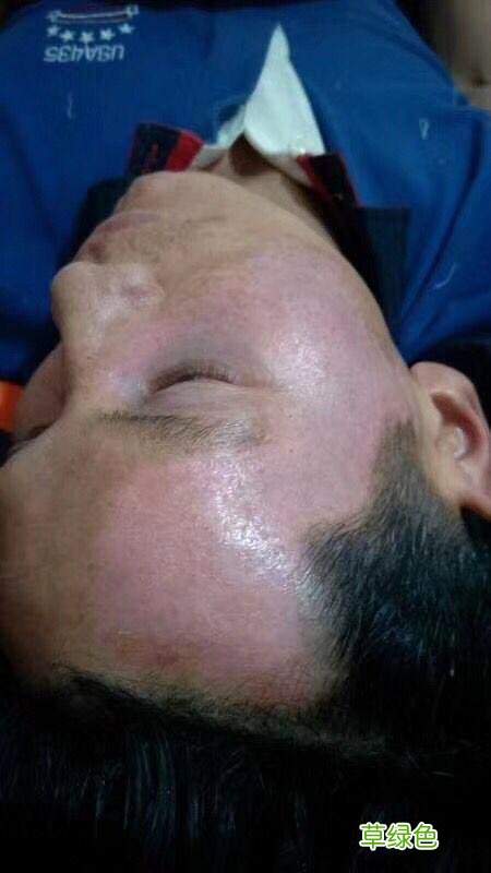 黑色胎记如何去掉 如何去掉胎记