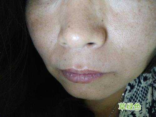 女生雀斑怎么去掉 雀斑怎么去掉