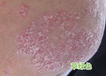 点状牛皮皮癣原因 牛皮癣症状图片