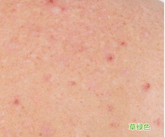 皮肤湿疹是什么样子的 皮肤湿疹怎么办