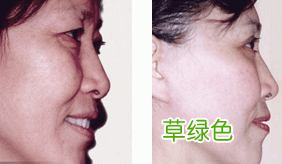 美白针效果怎么样 美白针的效果如何