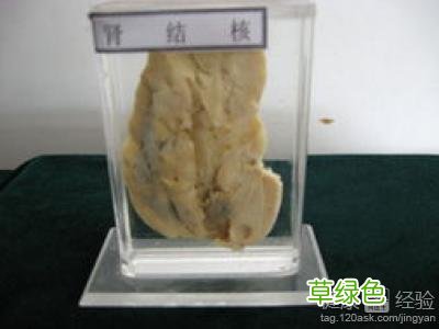 肾结核治疗多少钱 肾结核怎么治疗