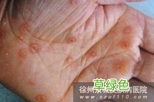 女性菜花病图片集 女性菜花病图片