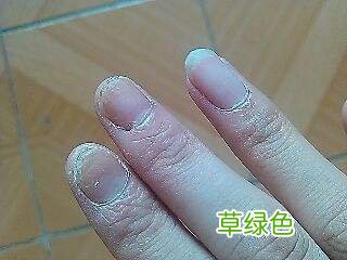 治灰指甲偏方 偏方治灰指甲